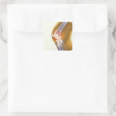 Vervanging knie. Röntgenfoto's, gekleurd, van een  Vierkante Sticker (Tas)