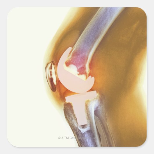 Vervanging knie. Röntgenfoto's, gekleurd, van een  Vierkante Sticker (Voorkant)