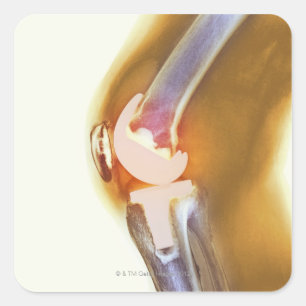 Vervanging knie. Röntgenfoto's, gekleurd, van een Vierkante Sticker