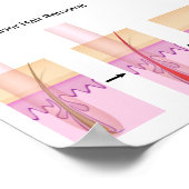 Verwijdering van laserhaar poster (Hoek)