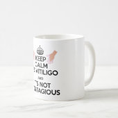 Vitiligo Awareness Day Mok! Koffiemok (Voorkant rechts)