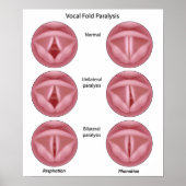 Vocale navelverlamming Poster (Voorkant)