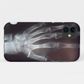 X-Ray Hand Telefoonhoes Case-Mate iPhone Case (Achterkant (horizontaal))