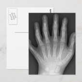 Zes Fingered Hand, Medische Zeldzaamheid, Briefkaart (Voorkant / Achterkant)