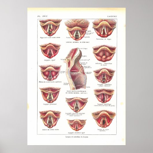 Ziekten van Larynx Anatomy Poster French (Voorkant)